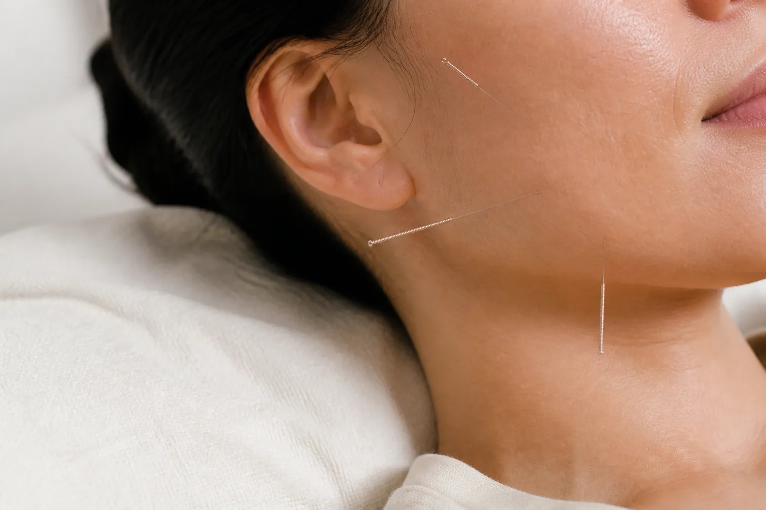 Fine facial acupuncture needles in clinic